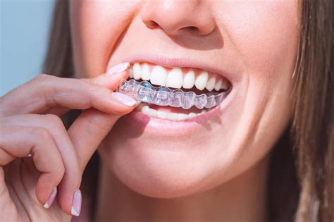 The Magical Tooth Aligner: A Game-Changer for Smile Enhancement